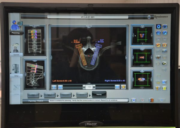 Mazor Robotics Renaissance Surgical Guidance System - DeoCorp